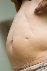 Fototapeta premium The old man's stomach and a scar from the surgery.