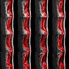 MRI Of Lumbar And Thoracic Vertebral Column Spine Showing Spinal Disc Herniation