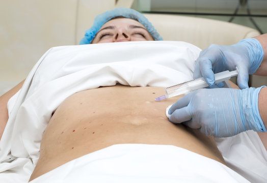 woman is in the process cellulite mesotherapy clinic