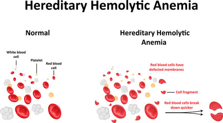 Hereditary Hemolytic Anemia - obrazy, fototapety, plakaty