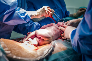 Classic cesarean section in the operating theater, labor room - obrazy, fototapety, plakaty