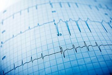 Electrocardiogram