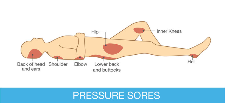 Pressure sores area on human body part.