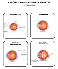 Diabetic Eye Diseases. Diabetic retinopathy,  cataract and glaucoma. Also healthy eye detailed anatomy. - obrazy, fototapety, plakaty