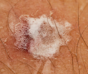 Fototapeta premium wound on the leg treated with peroxide