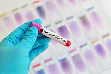 Fototapeta premium Blood for hemophilia test