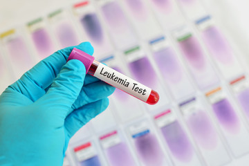 Blood sample for leukemia testing