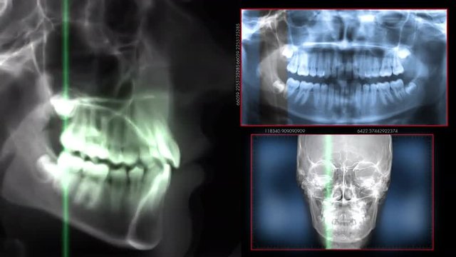 Digital dental scan