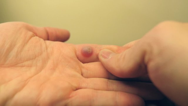 Wart blister examine left hand