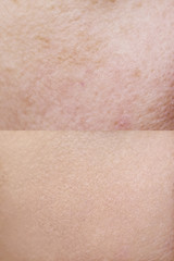 Skin before and after treatment