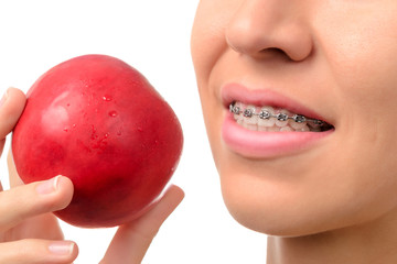 Female teeth with dental braces and red apple