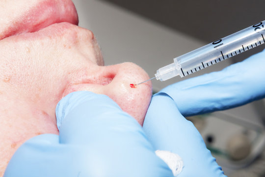 Microsurgery: Local anesthesia on the nose