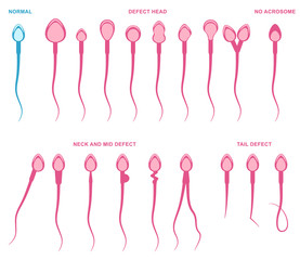 normal and abnormal sperm
