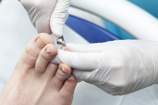 Cutting toe nails bij pedicure