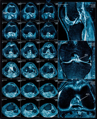 Magnetic resonance tomography (MRT) images of knee