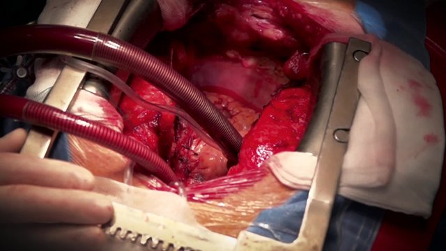 Heart operation in ascending aortic aneurysm