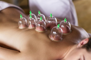 Woman with cupping treatment on back
