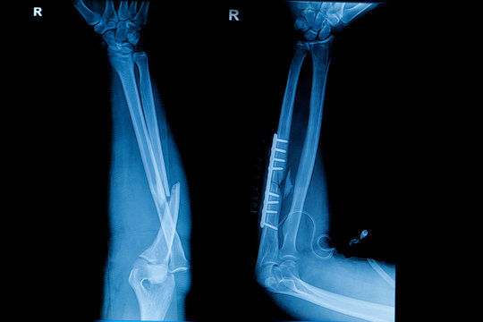 Collection of human x-rays  showing fracture  of radius  bone ,