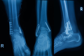 Collection of human x-rays  showing fracture of right leg ( fracture both bones )