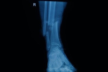 Collection of human x-rays  showing fracture of right leg