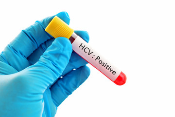 Obraz premium Blood sample with hepatitis C virus (HCV) positive