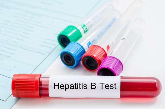 Blood sample for hepatitis B virus (HBV) testing.