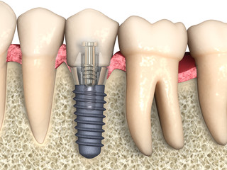 Dental anatomy - Dental implant with bone structure, teeth and gum section