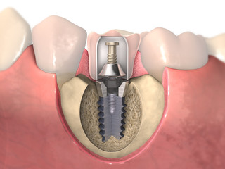 Dental anatomy - Dental implant with bone structure, teeth and gum section © lightmachine