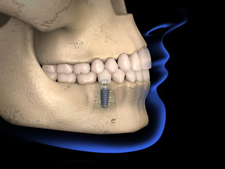 Dental anatomy - Dental implant with bone structure, upper and lower teeth