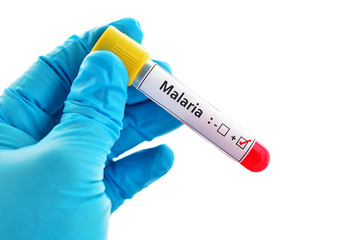 Malaria positive blood sample