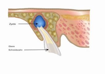zyste am schneidezahn