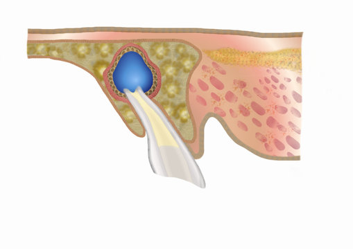 zyst an schneidezahn