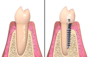 Dental anatomy - Dental implant with bone structure, teeth and gum section © lightmachine