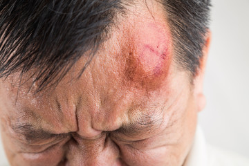 Fototapeta premium Selective focus on painful red swollen forehead injury