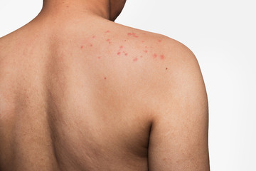 man with dermatitis problem of rash