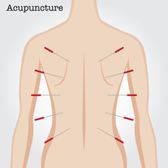 Getting acupuncture treatment.