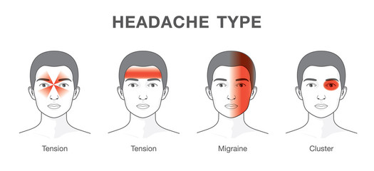Headaches 4 type on different area of patient head.Illustration about heath care and medical