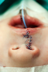 Boy laying on the operating table after a plastic surgery on the lip.