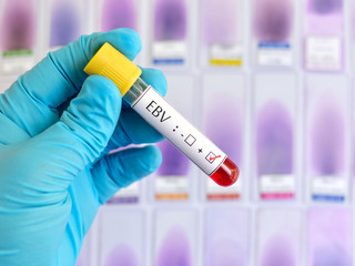Fototapeta premium Epstein-Barr virus (EBV) positive