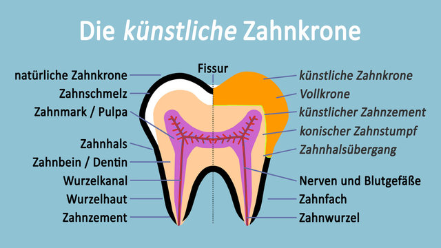ts13 ToothSign - Abbildung t&uuml;rkis - Backenzahn im Schnitt - Die k&uuml;nstliche Zahnkrone - 16zu9 g4120