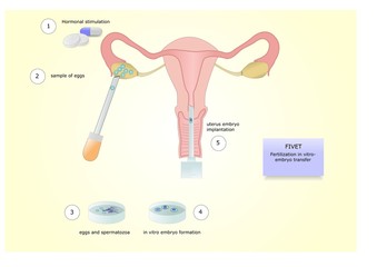 fivet (Fertilization In Vitro Embryo Transfer), una tecnica di fertilizzazione assitita, con impianto nell'utero di un embrione prodotto in vitro