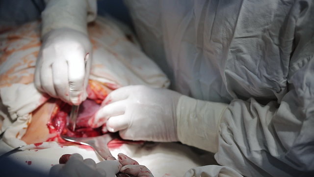 Caesarean section, surgeon cutting stomach with scalpel, extreme close-up shot.