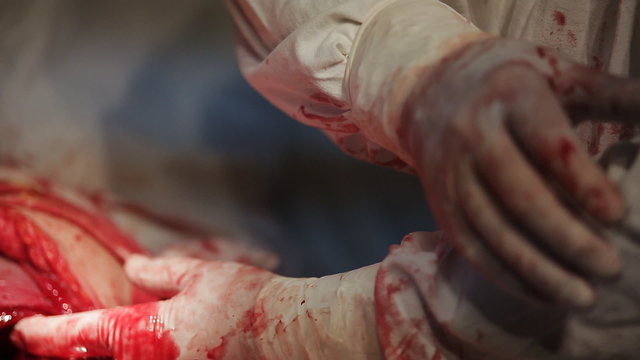 cesarean section in operating theater. The doctor sews up the incision abdomen