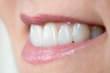 Obraz premium close up of a mouth and restored teeth