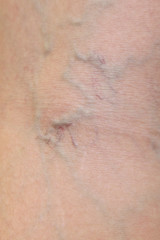 Fototapeta premium close-up on varicose veins on the skin