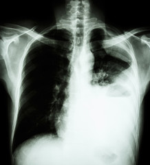 Lung cancer ( film x-ray of chest PA upright : show pleural effusion at left lung due to lung cancer )  ( 2 type of lung cancer : Non-small cell lung cancer , Small cell carcinoma )