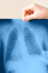 Doctor check a lung x-ray