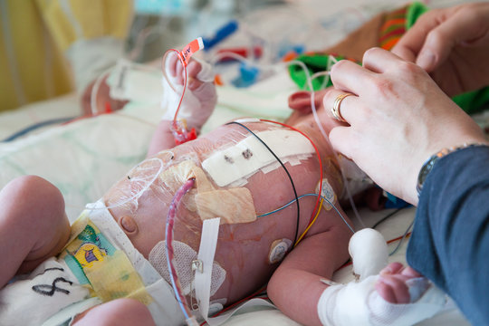 Intensive care after heart surgery, infant child and caring hands helping.