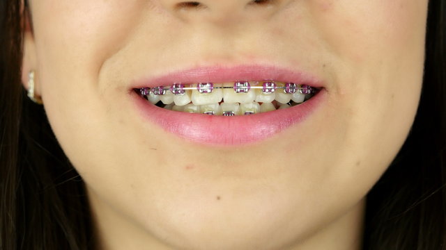 smiling young girl with braces on teeth