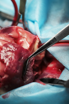 Heart operation closeup